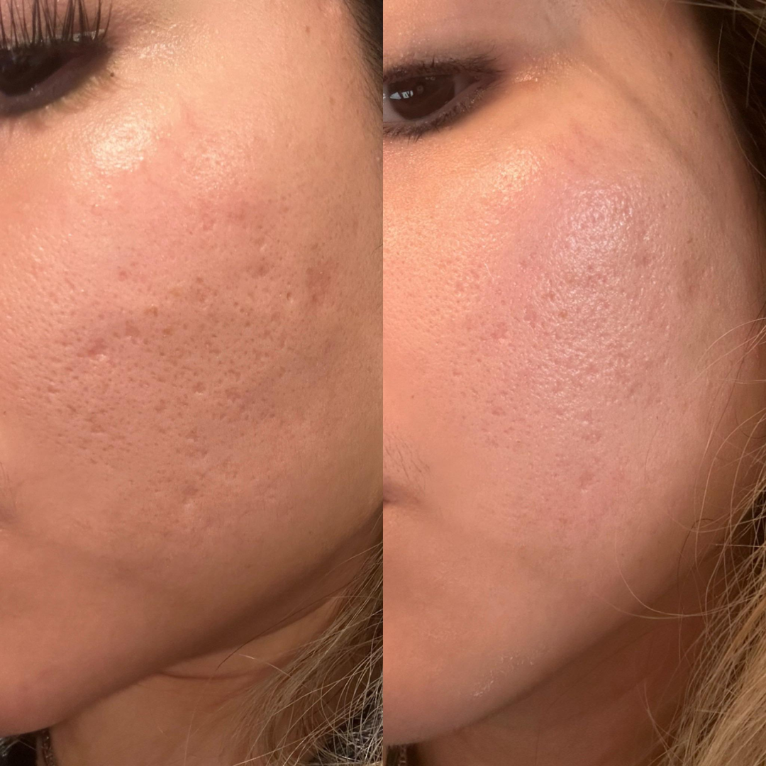 Prequel Silicone Scar Stick | Reduces Scars, Stretch Marks & Warts with Onion Extract + Centella Asiatica + Vitamin E | Smooth & Even Skin