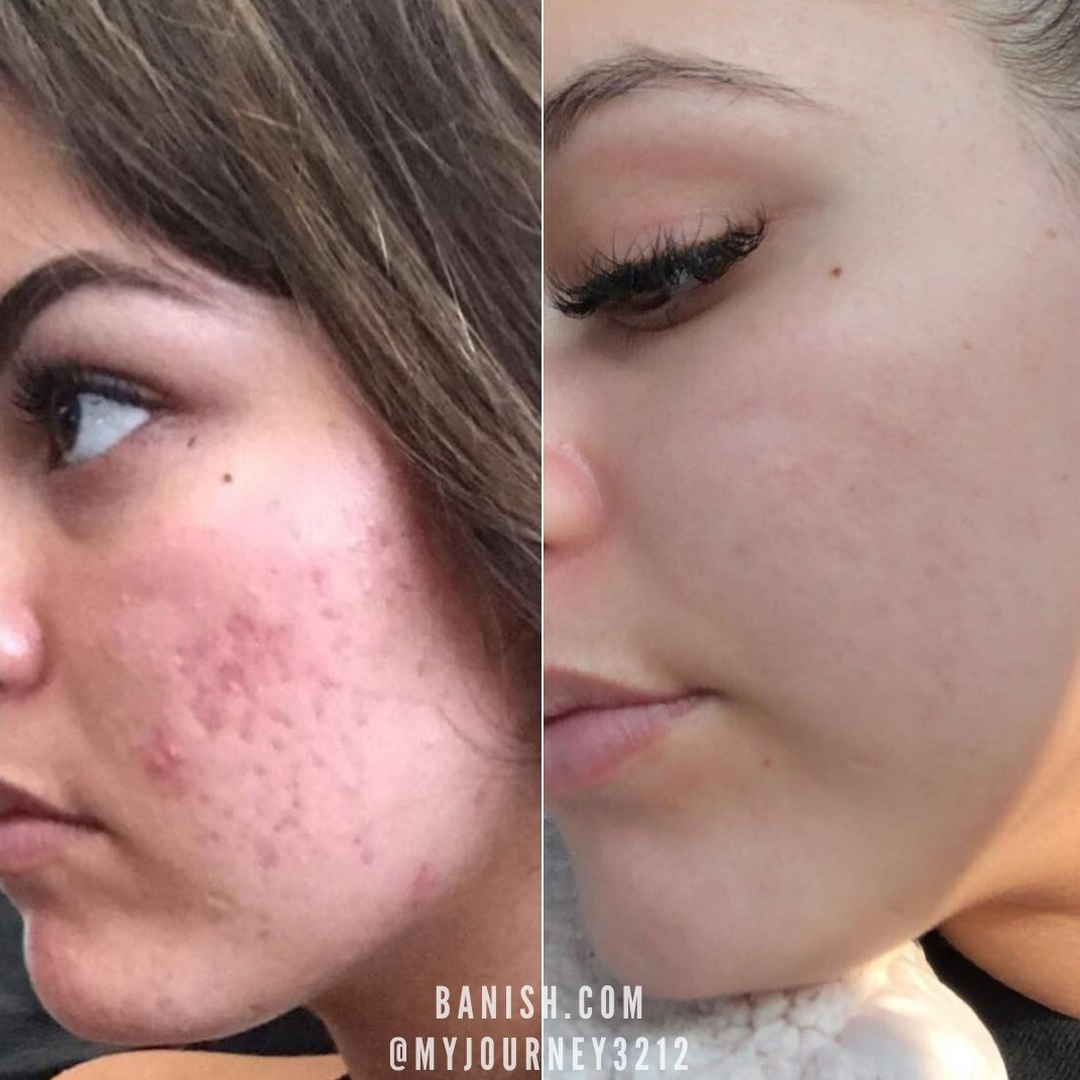 Prequel Silicone Scar Stick | Reduces Scars, Stretch Marks & Warts with Onion Extract + Centella Asiatica + Vitamin E | Smooth & Even Skin