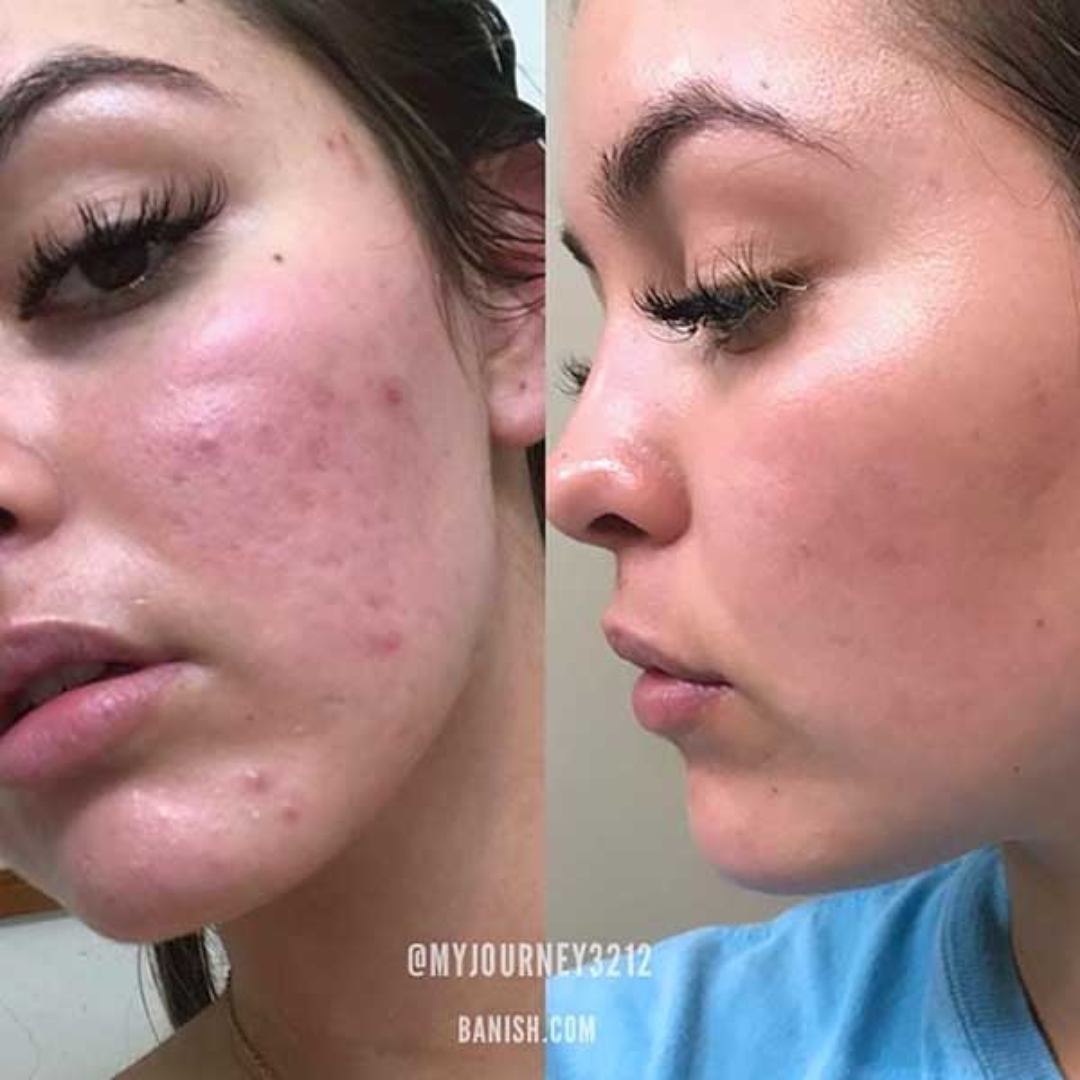 Prequel Silicone Scar Stick | Reduces Scars, Stretch Marks & Warts with Onion Extract + Centella Asiatica + Vitamin E | Smooth & Even Skin