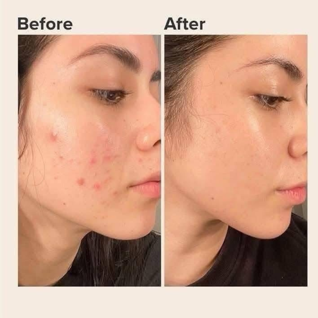 Orien Soothing Spray Toner for Spotless Skin - Removes Acne, Fades Dark Spots, Reveals Glow