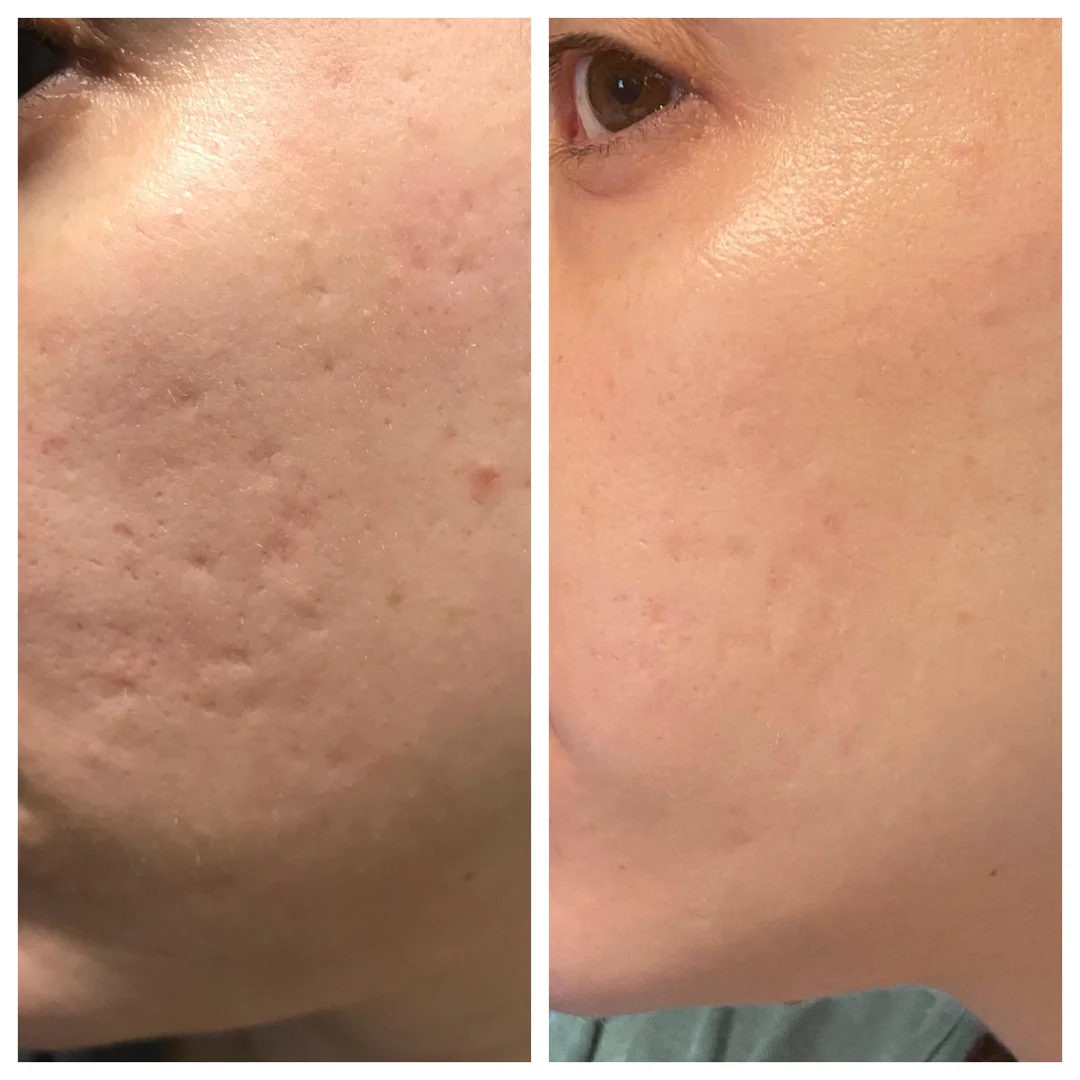 Prequel Silicone Scar Stick | Reduces Scars, Stretch Marks & Warts with Onion Extract + Centella Asiatica + Vitamin E | Smooth & Even Skin